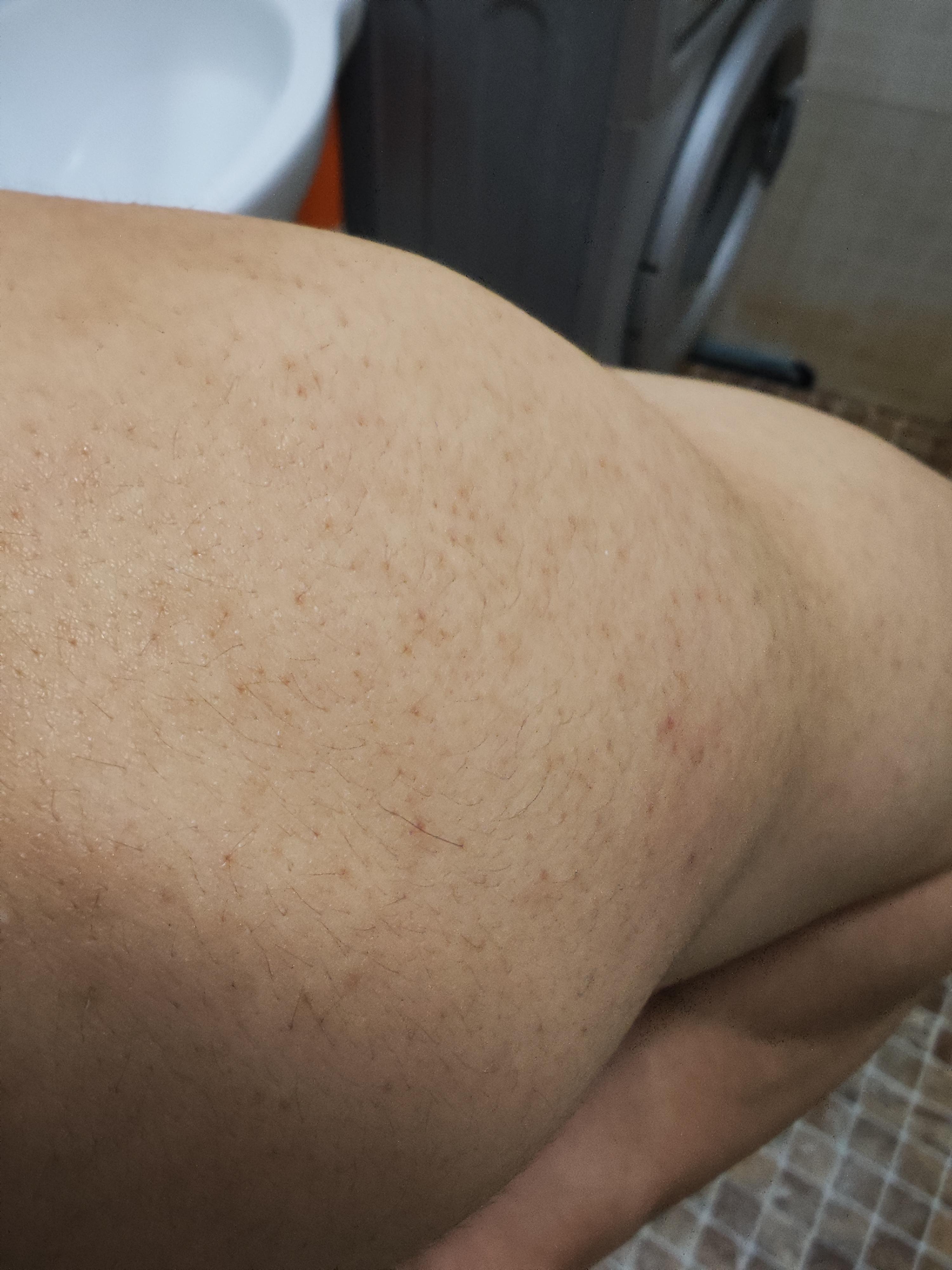 林夕爱健身 的想法: 请问我肩膀上的毛孔为什么这样?