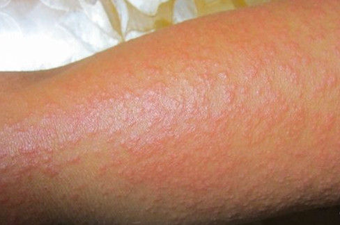 伍茗 的想法: 怎么预防日光性过敏