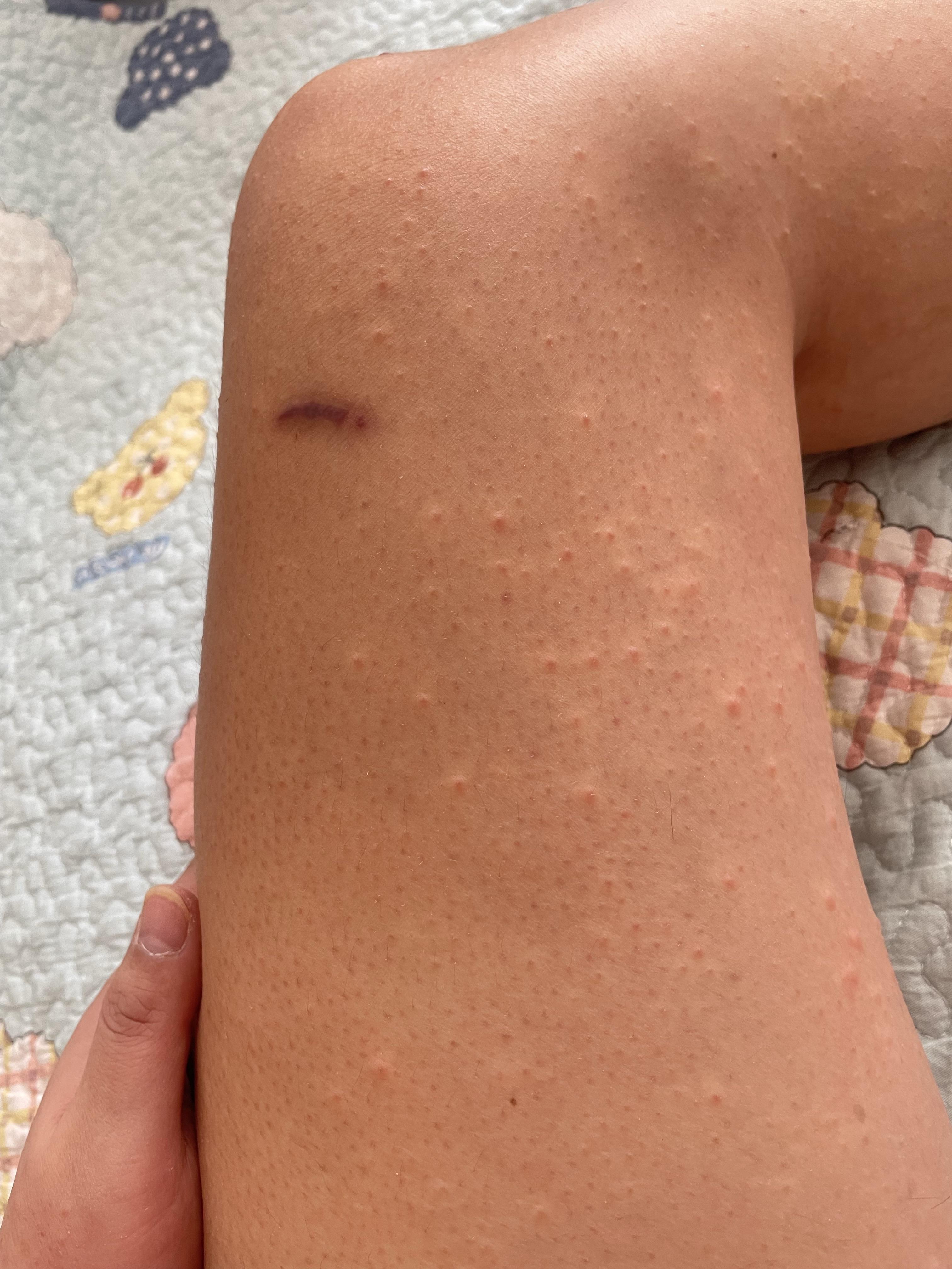 上起了好多小红胞此时还没觉得痒老公说有可能是是湿疹他就是湿疹患者