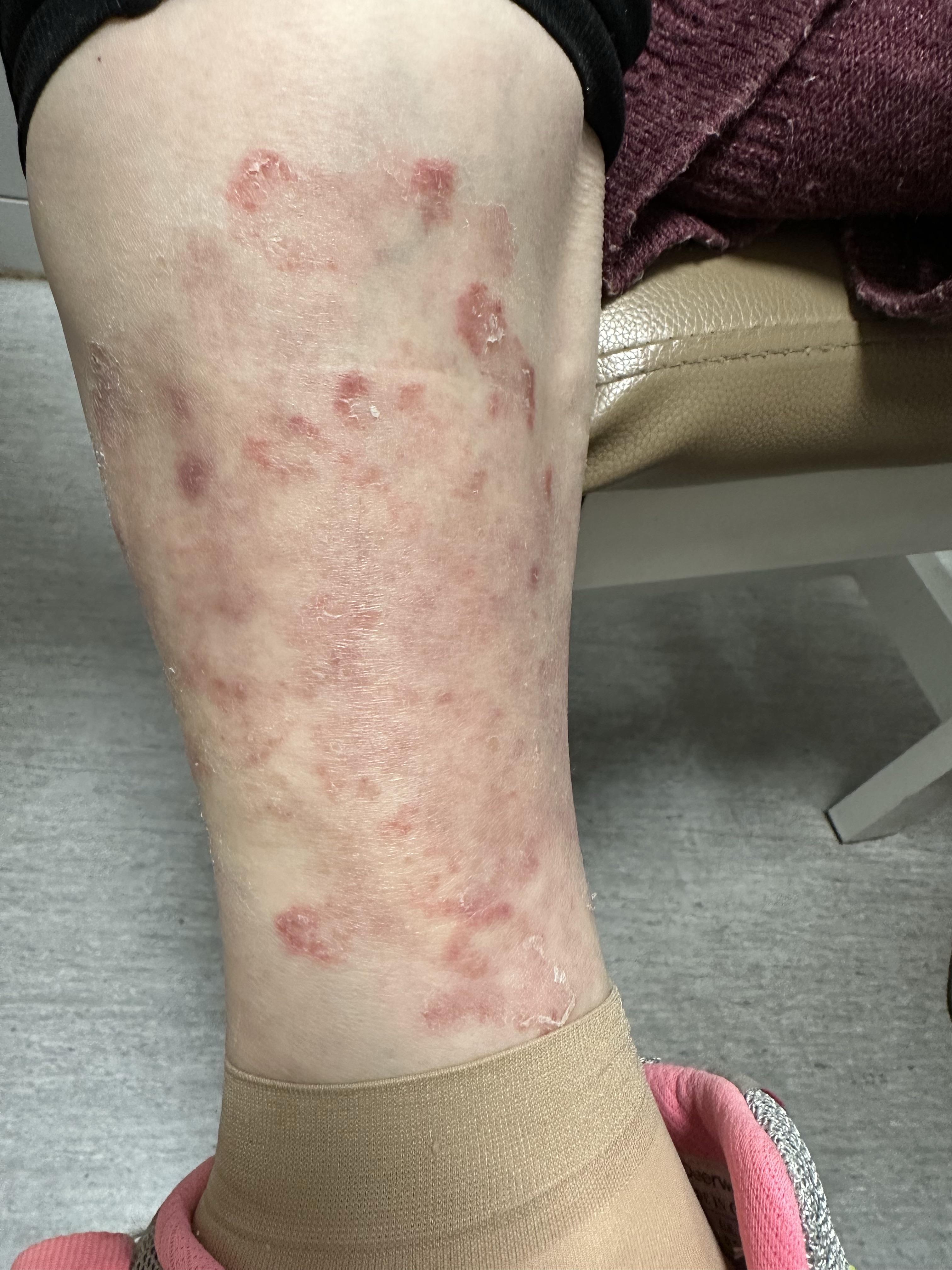 为什么会突然长体癣