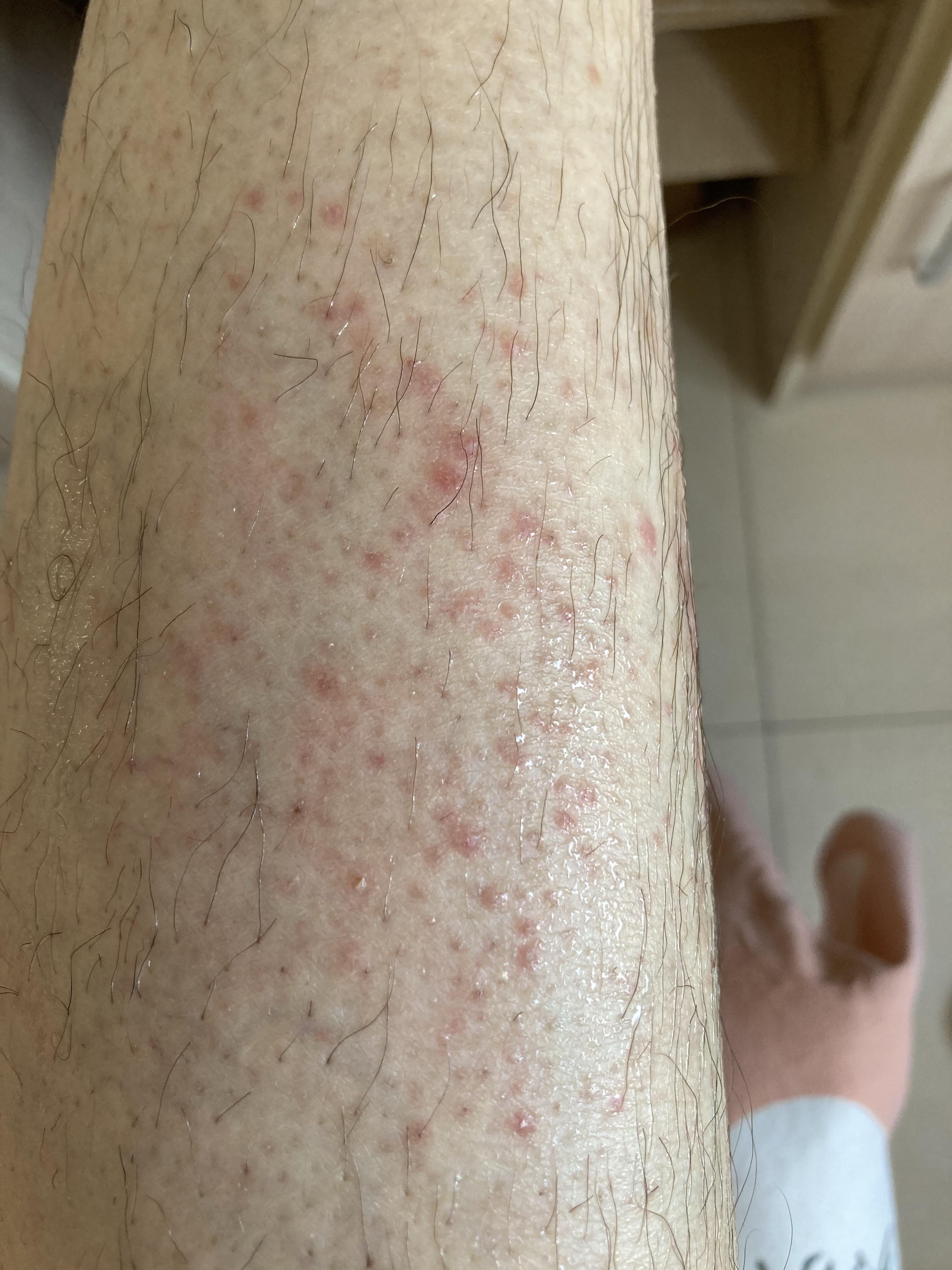 小腿上的红点是什么?有时候痒,是皮肤病吗请问大家?