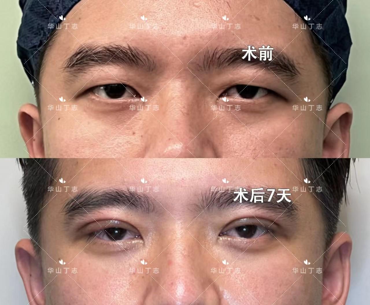 术后3个月眼睛明显更大有神了! - 知乎