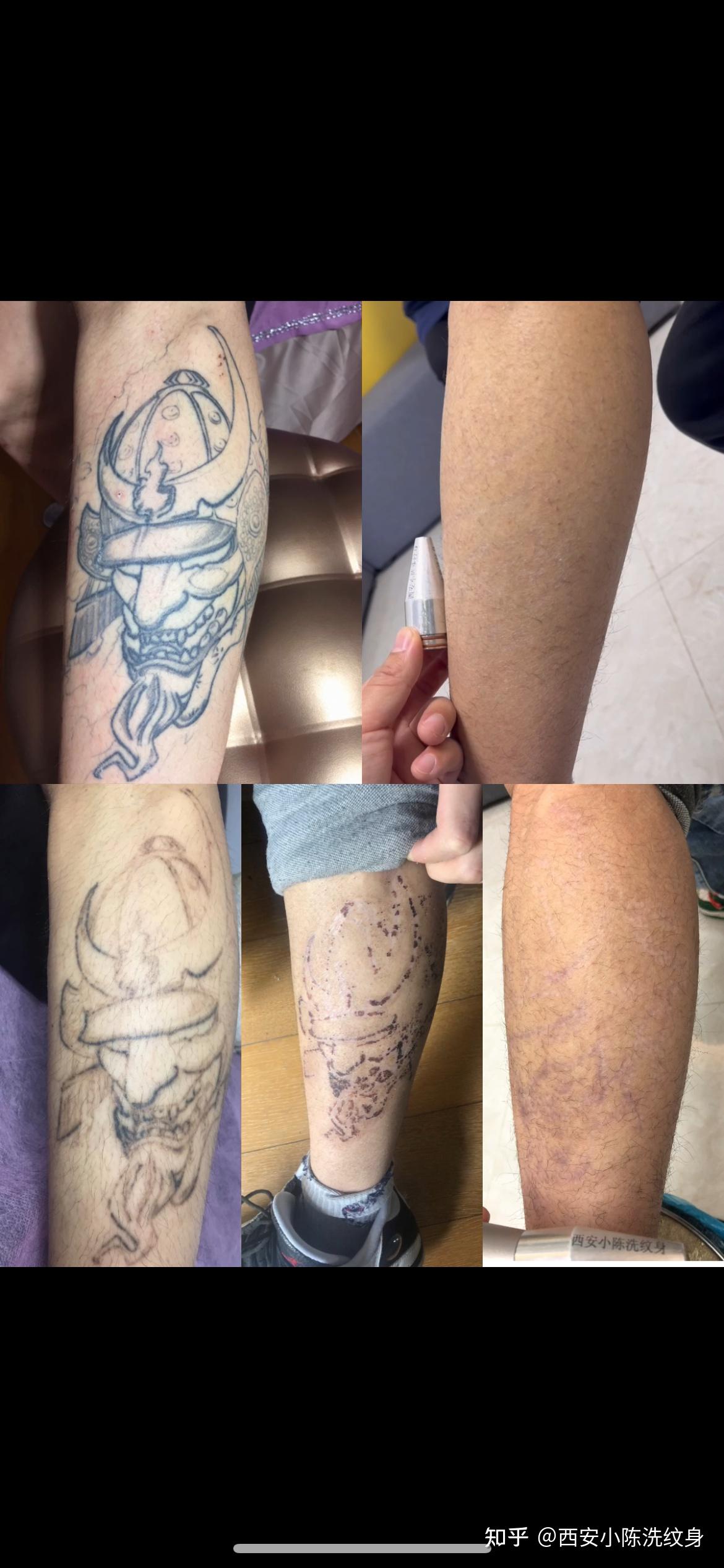 西安小陈洗纹身 - 知乎
