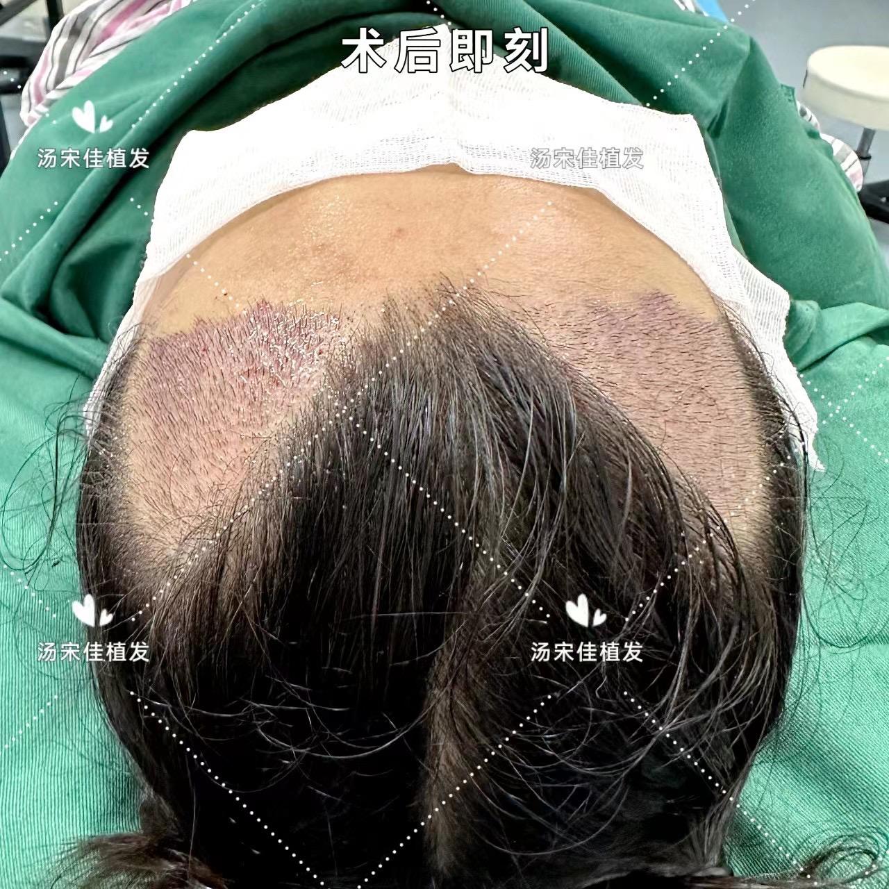 女人植发管用吗(女性植发贴吧)