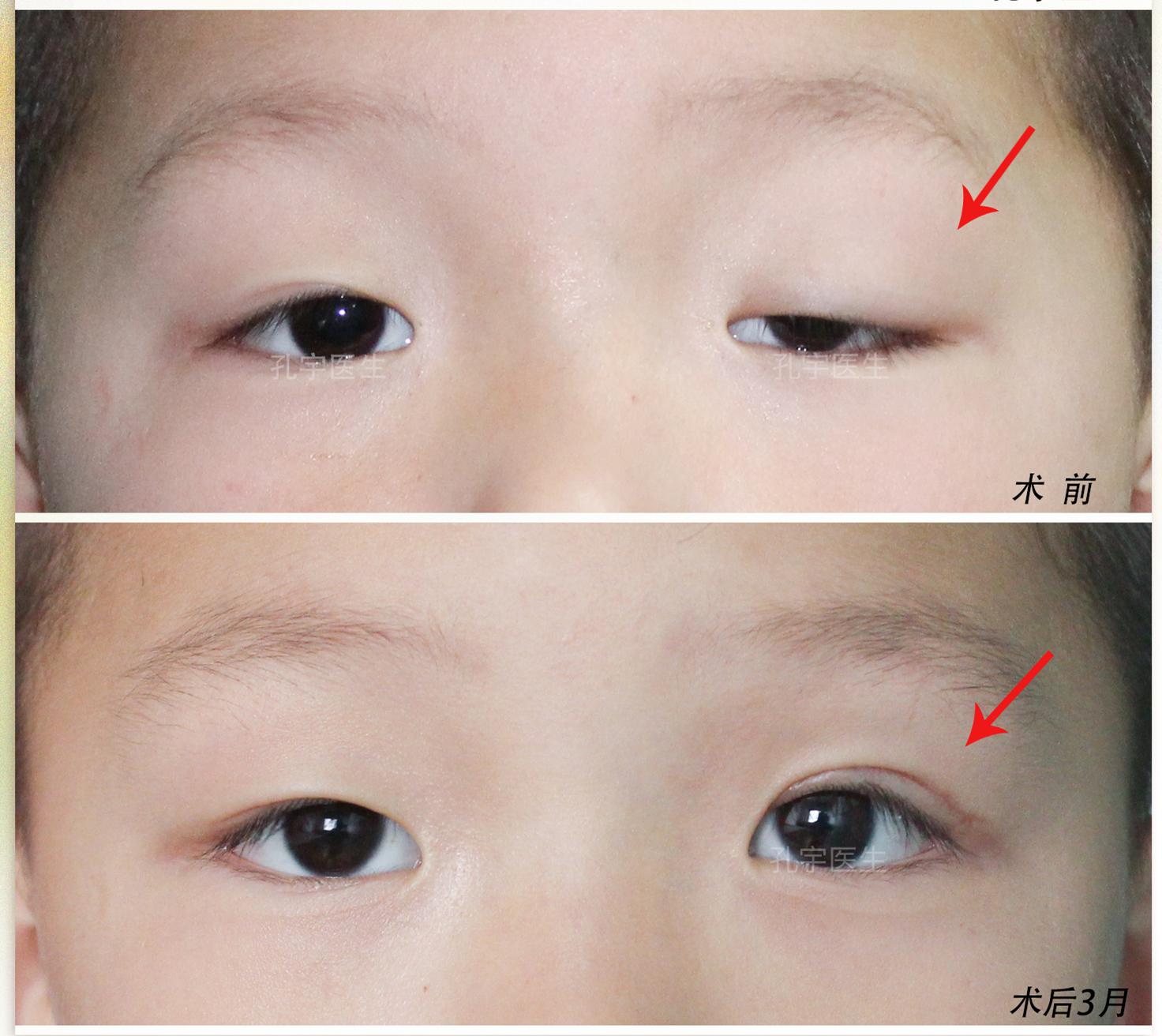 先天性重度上睑下垂又挽救了一个重度上睑下垂的4岁小宝贝孩子妈妈说