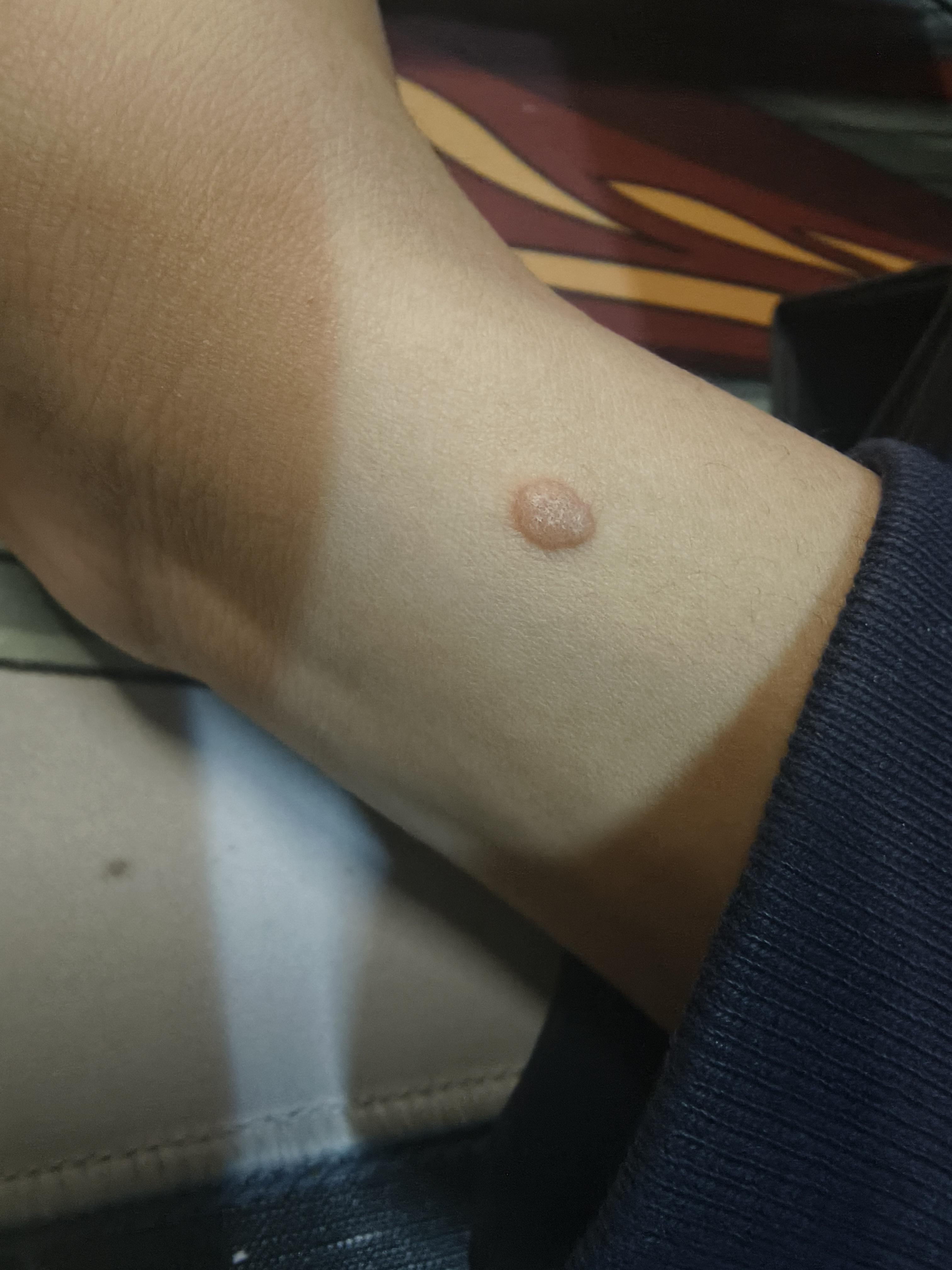 请问是硬下疳吗?存在好多年了