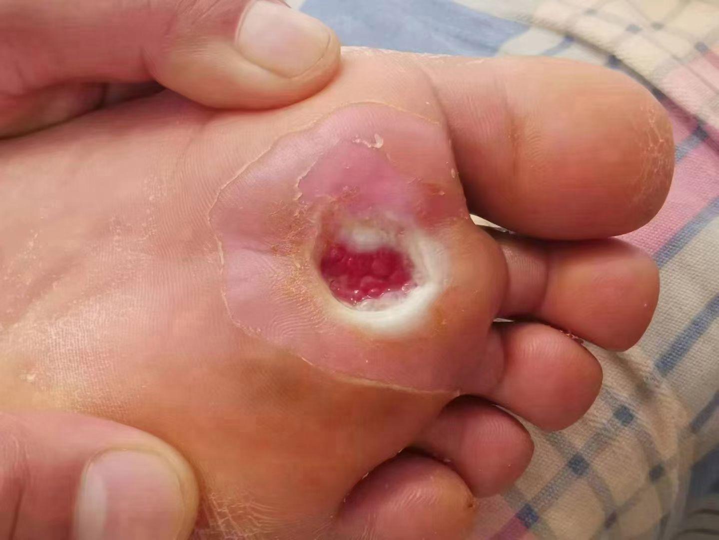 菠萝波儿 的想法: 糖尿病足