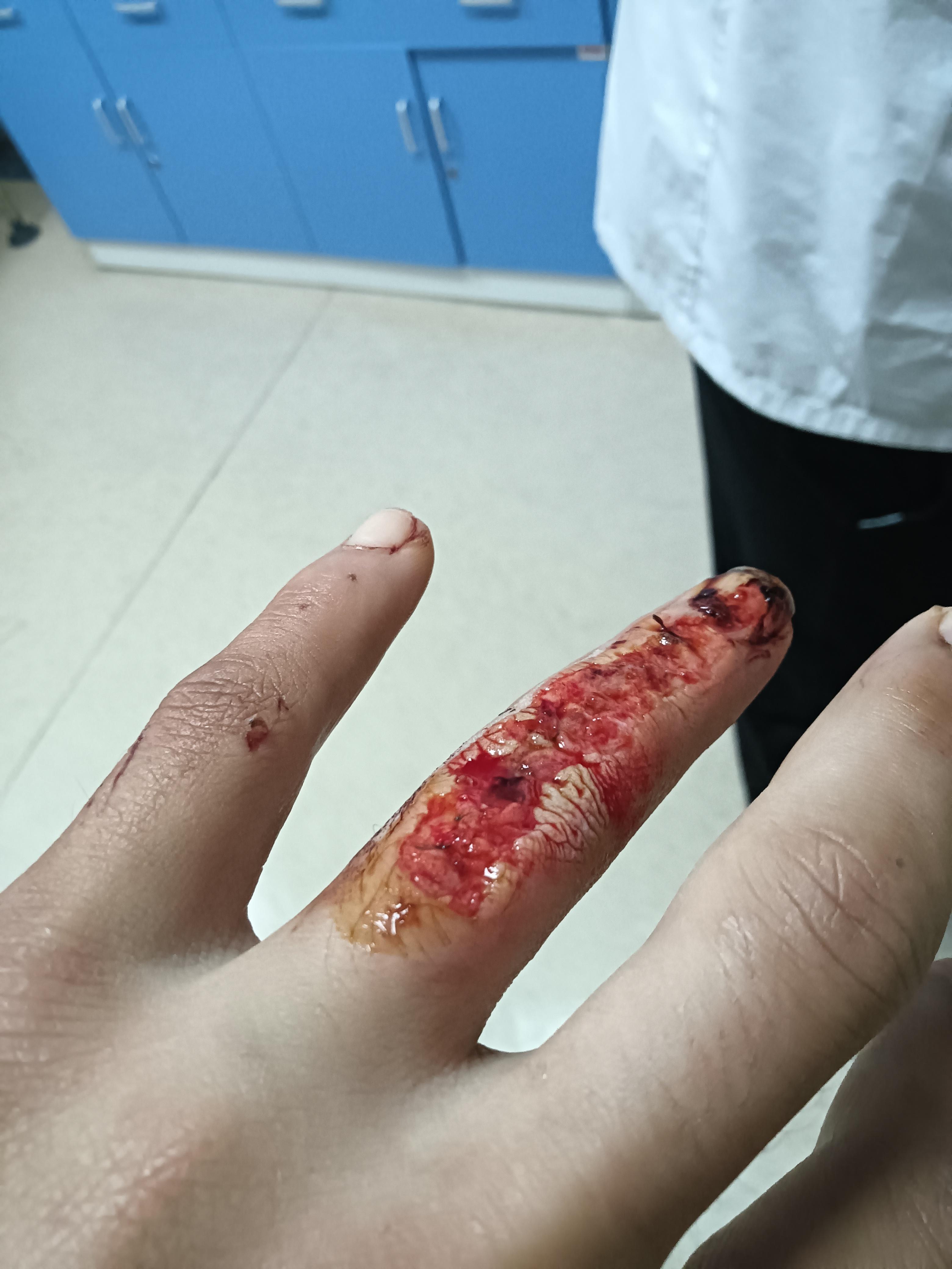 工伤造成左环指背侧皮肤软组织,伸肌腱及骨关节面损伤缺损手指损伤