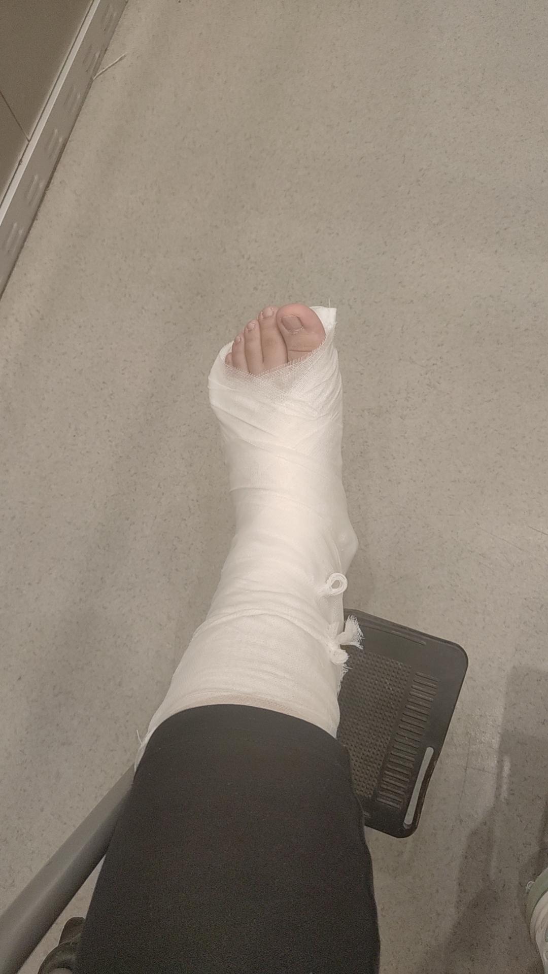木与子 的想法: 记录左脚骨折全过程