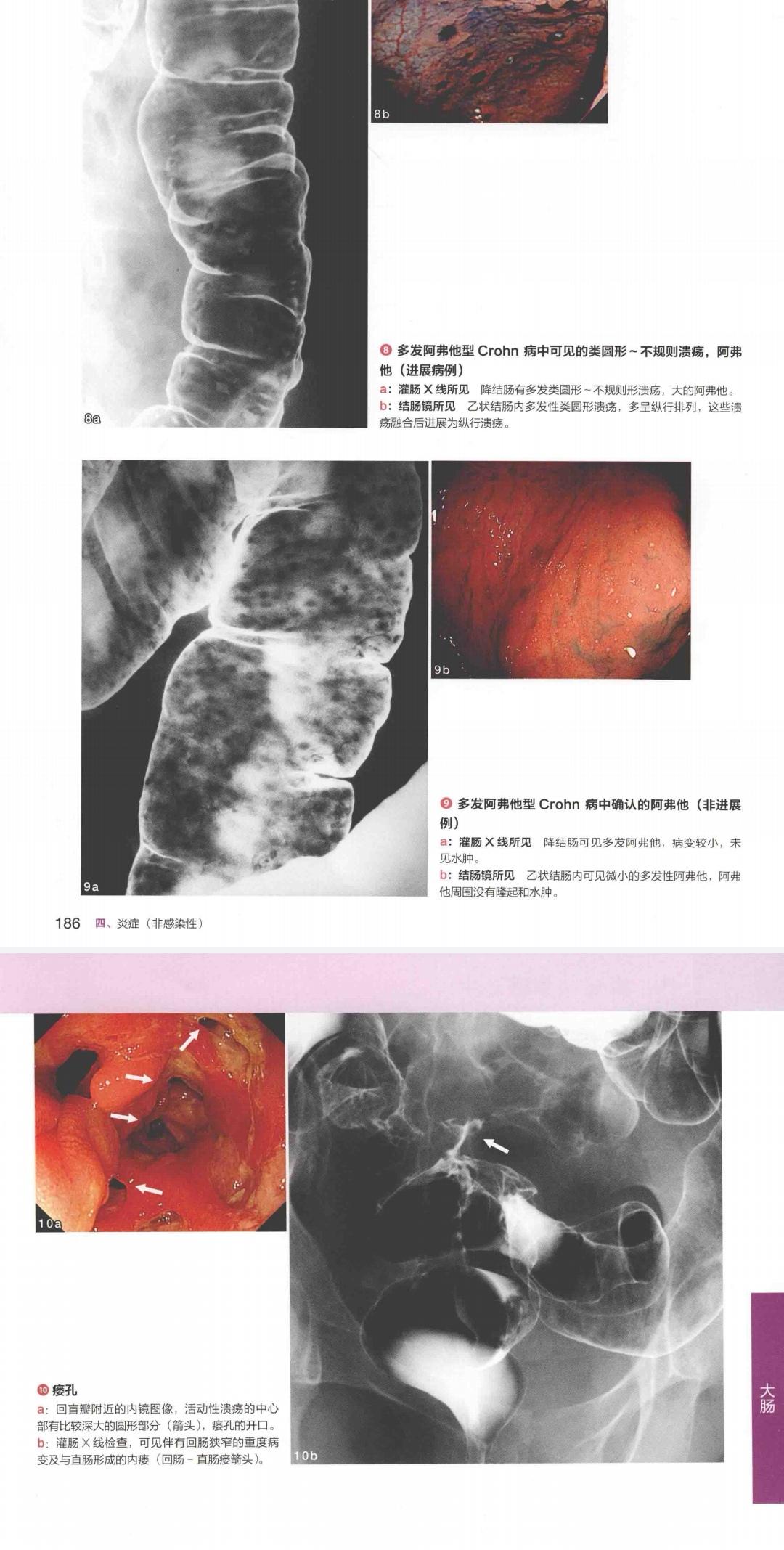 医万个为什么 的想法: 克罗恩病的鉴别诊断之肠结核 | 克罗恩病的诊断