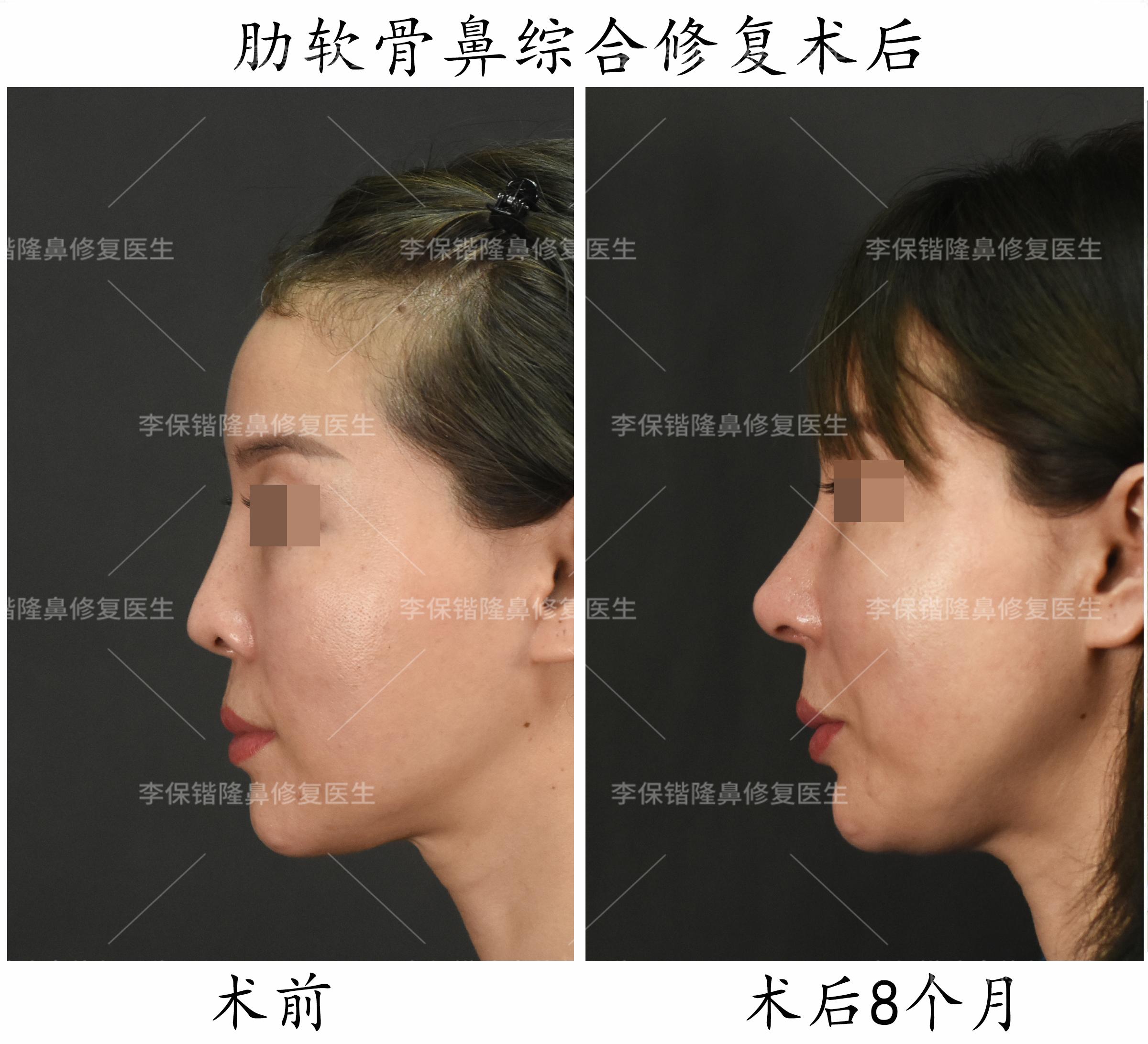 注射整形鼻子价格多少钱_鼻子注射整形价格_注射整形鼻子价格多少