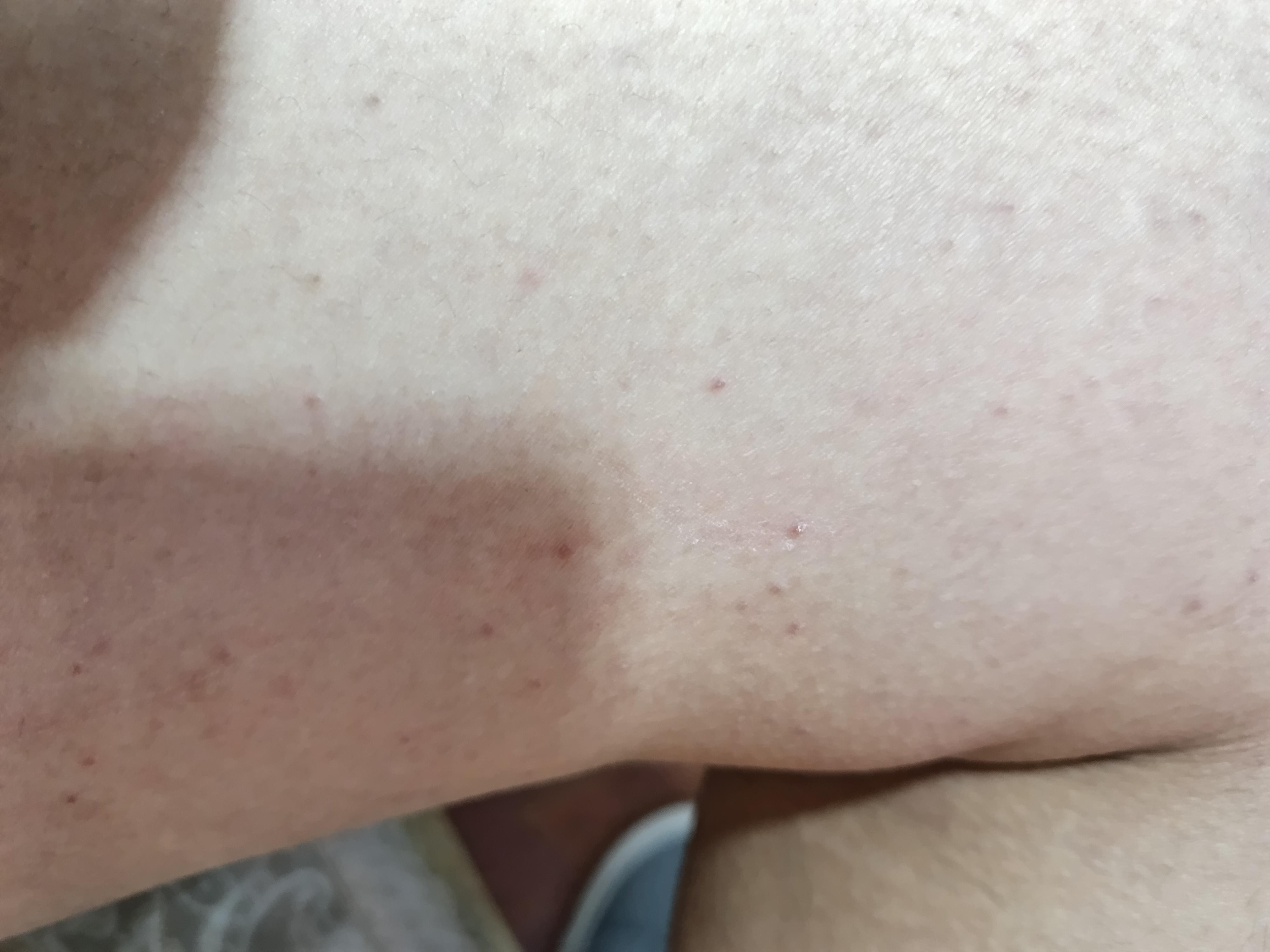 dzl 的想法: 大腿内侧这是什么疹子?