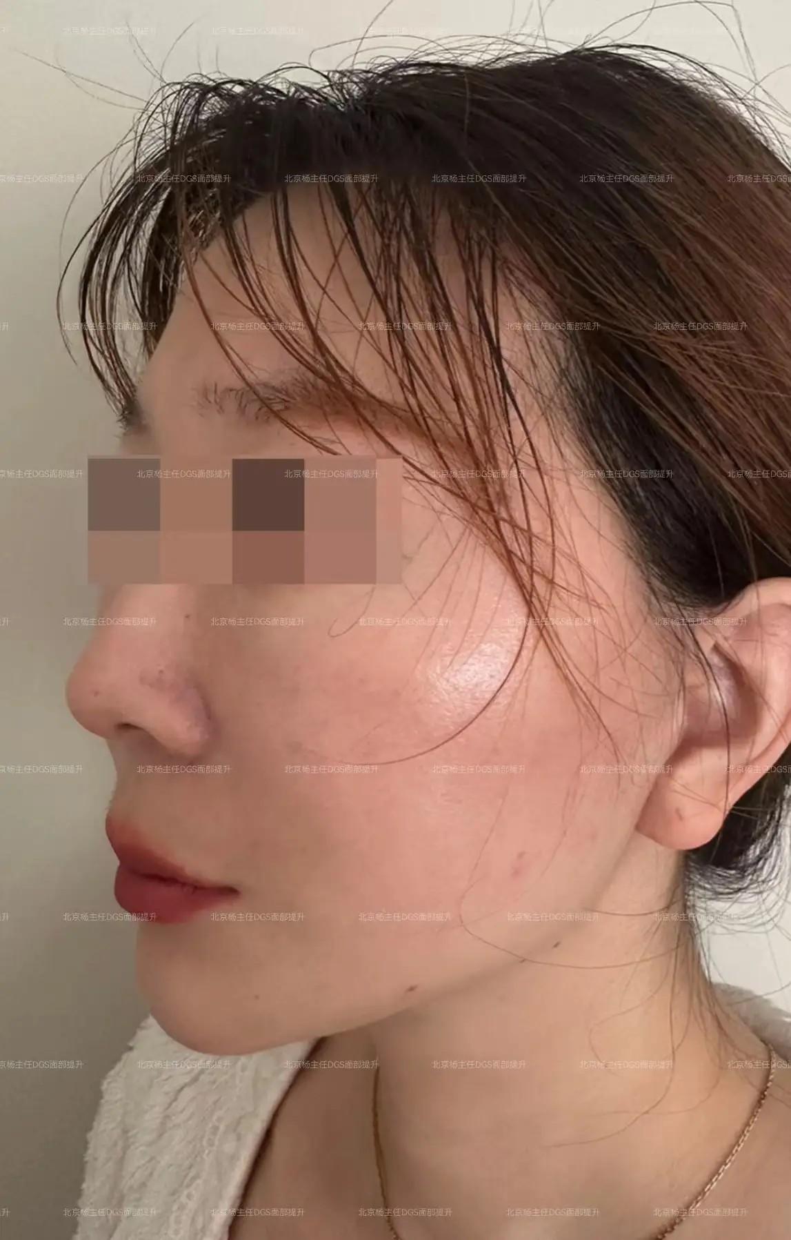 北京面部拉皮杨俊 的想法 39岁做小切口拉皮你们看值不值?