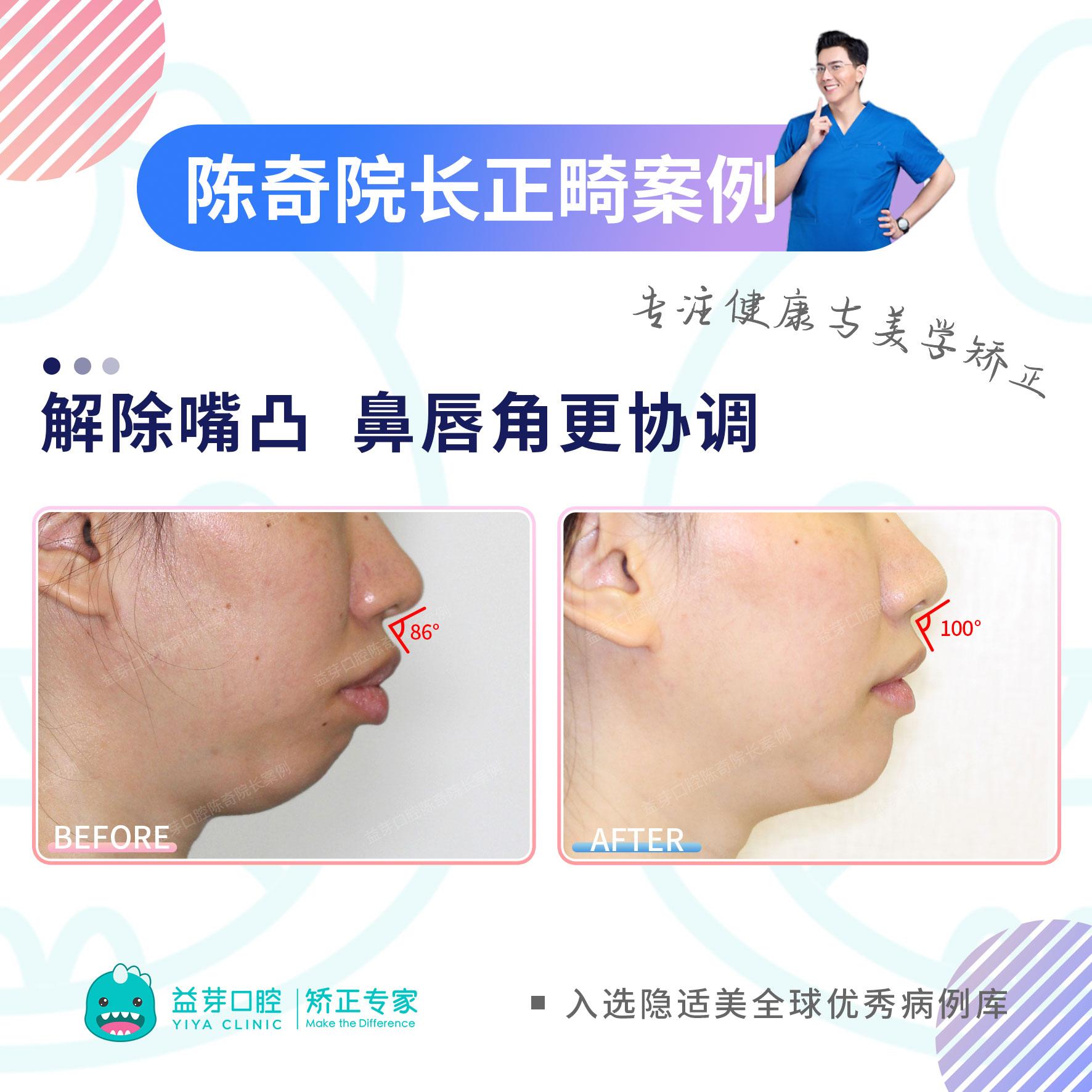 经常在正畸医生的科普和案例里看到"控根移动"这个词.可能大家