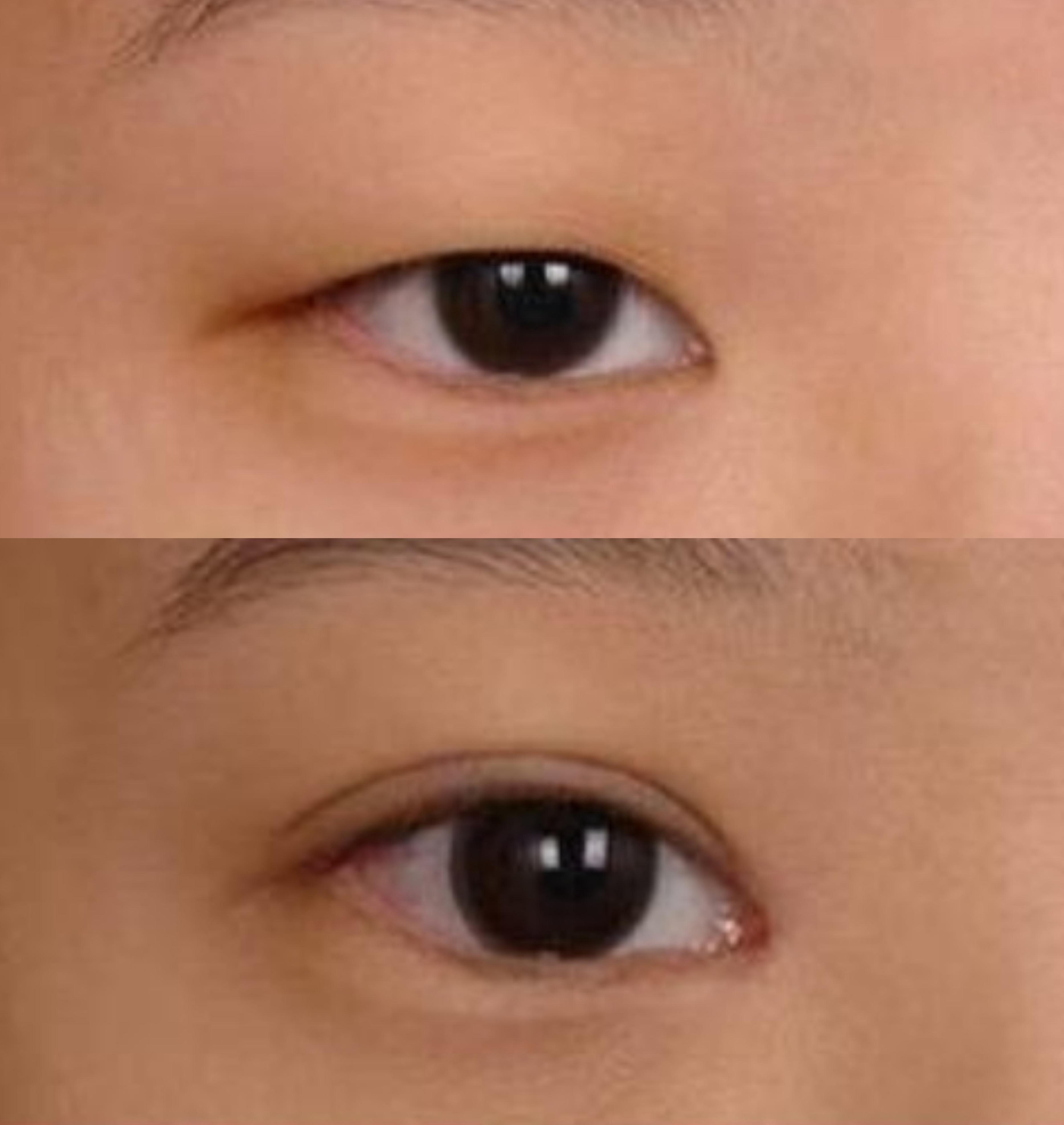 鼻大叔杜亚旭医生 的想法: 上眼皮提肌无力,做了提肌矫正术变化明显吗