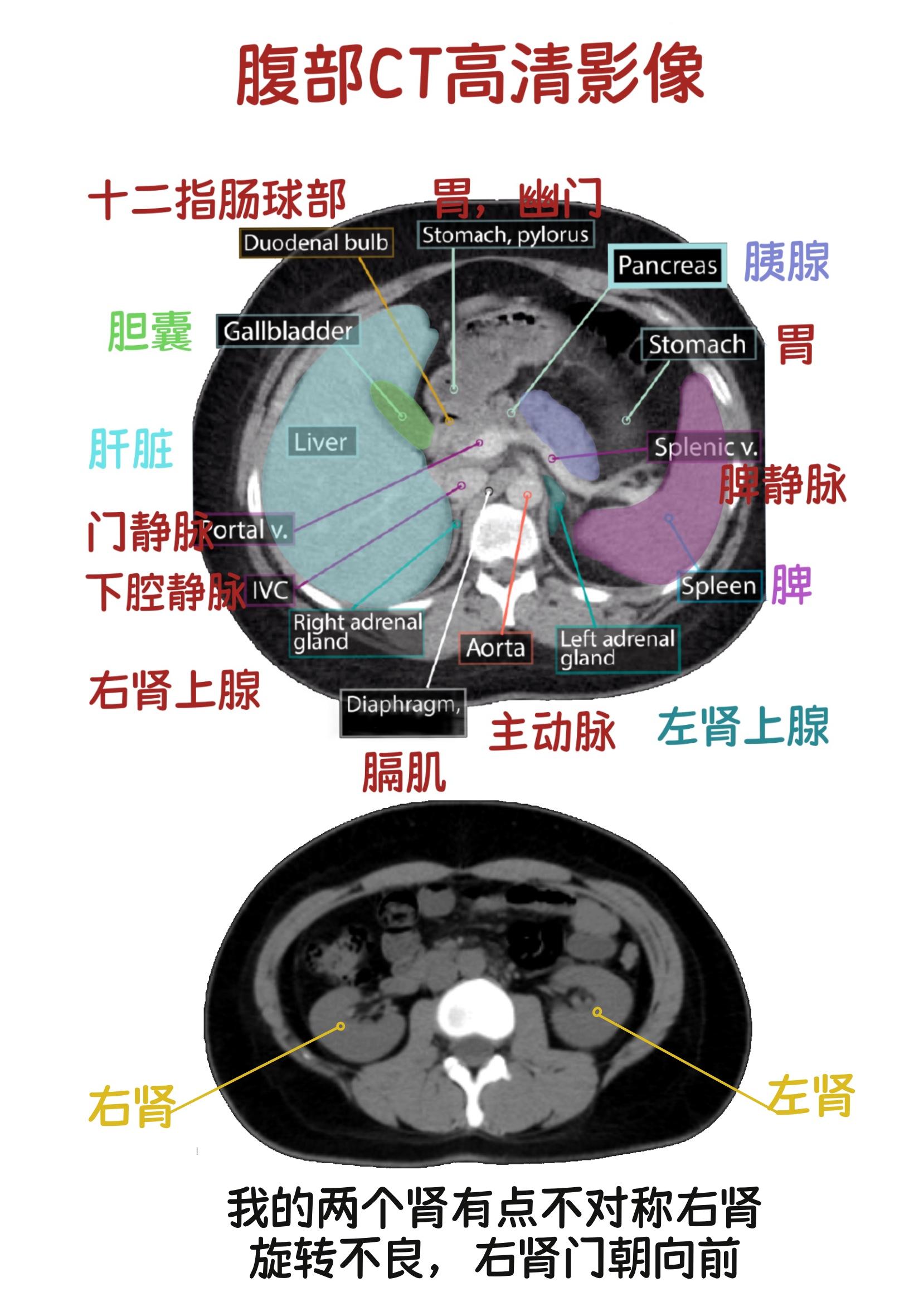 认真学医的小锅锅 的想法: 科普139 腹部影像解读