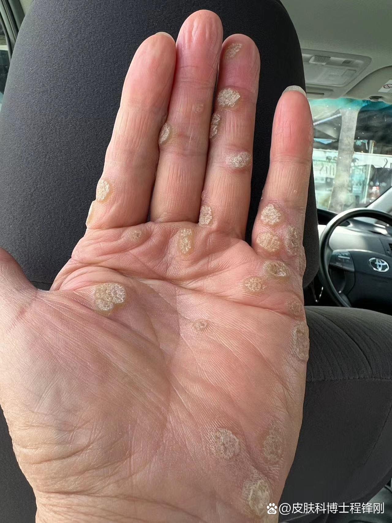 一只手,近三十个疣体,七年了,越来越多,怎么办?