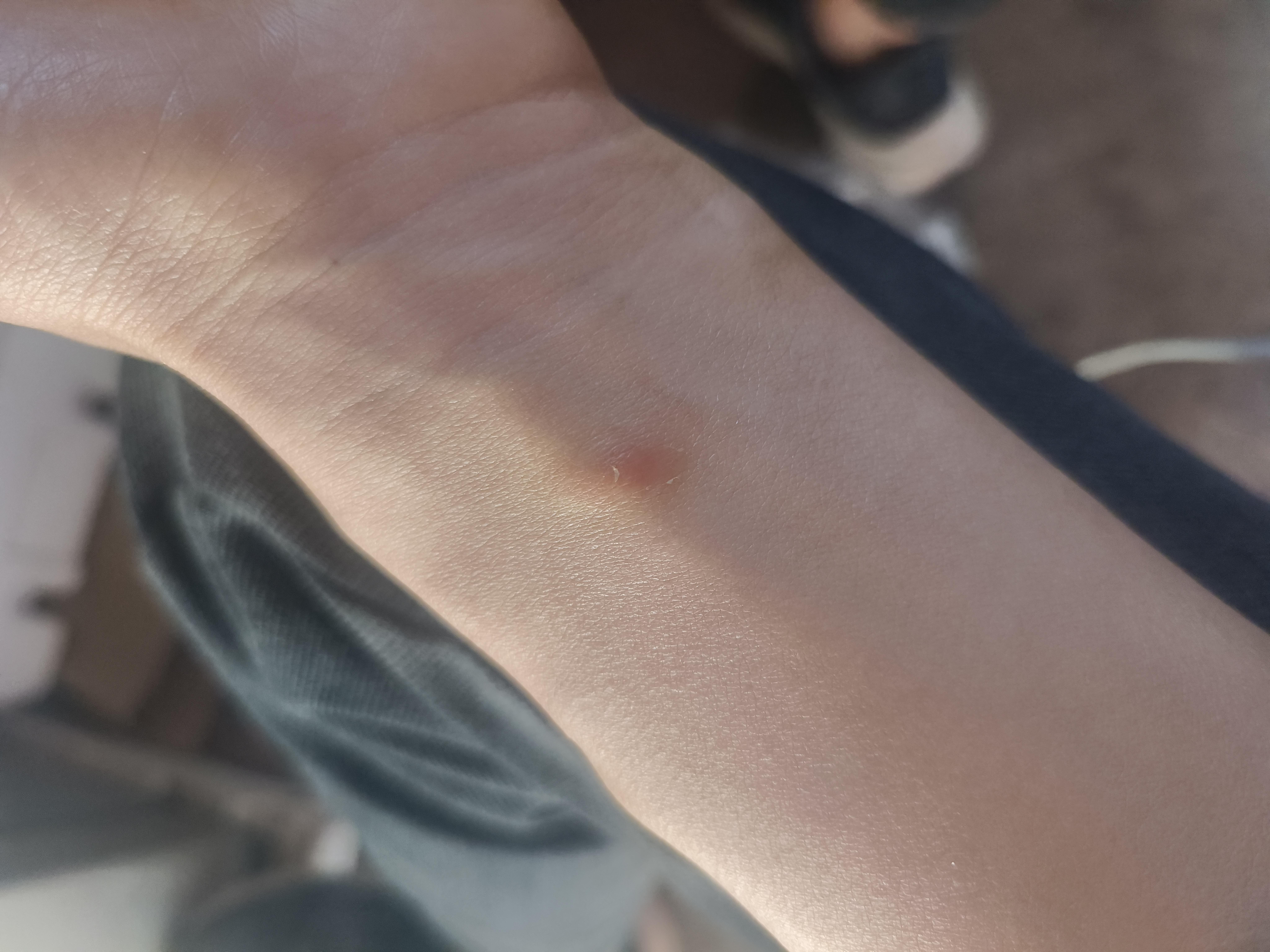 知乎用户dzcwtl 的想法: 这是不是艾滋病"卡波西肉瘤"