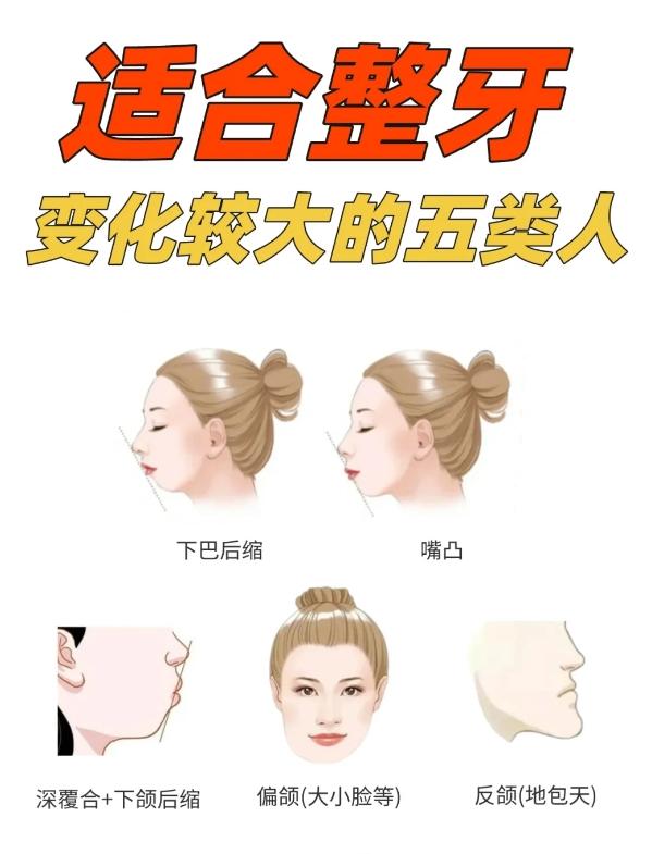 颜值可以说是飞升了~ 1️⃣凸嘴龅牙 牙齿表现:嘴凸通常伴随着