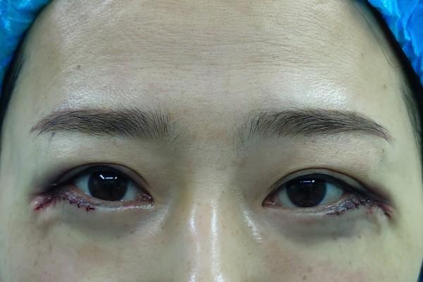 整形医生郑永生 的想法: 【下睑修复案例分享】这位女性来自祖国