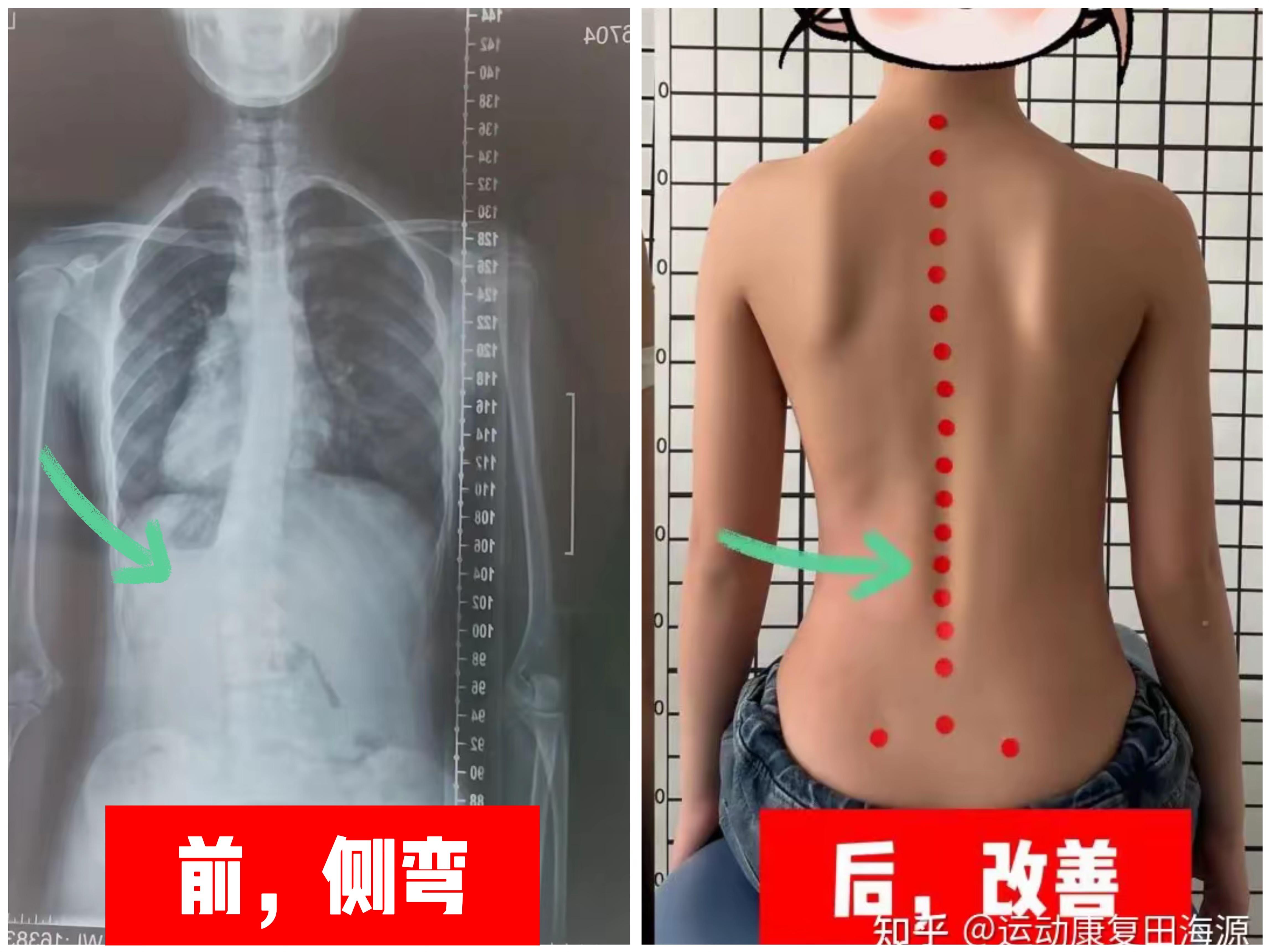 大海之源运动康复 的想法: 12岁,3个月,25度脊柱侧弯基本恢复正常!