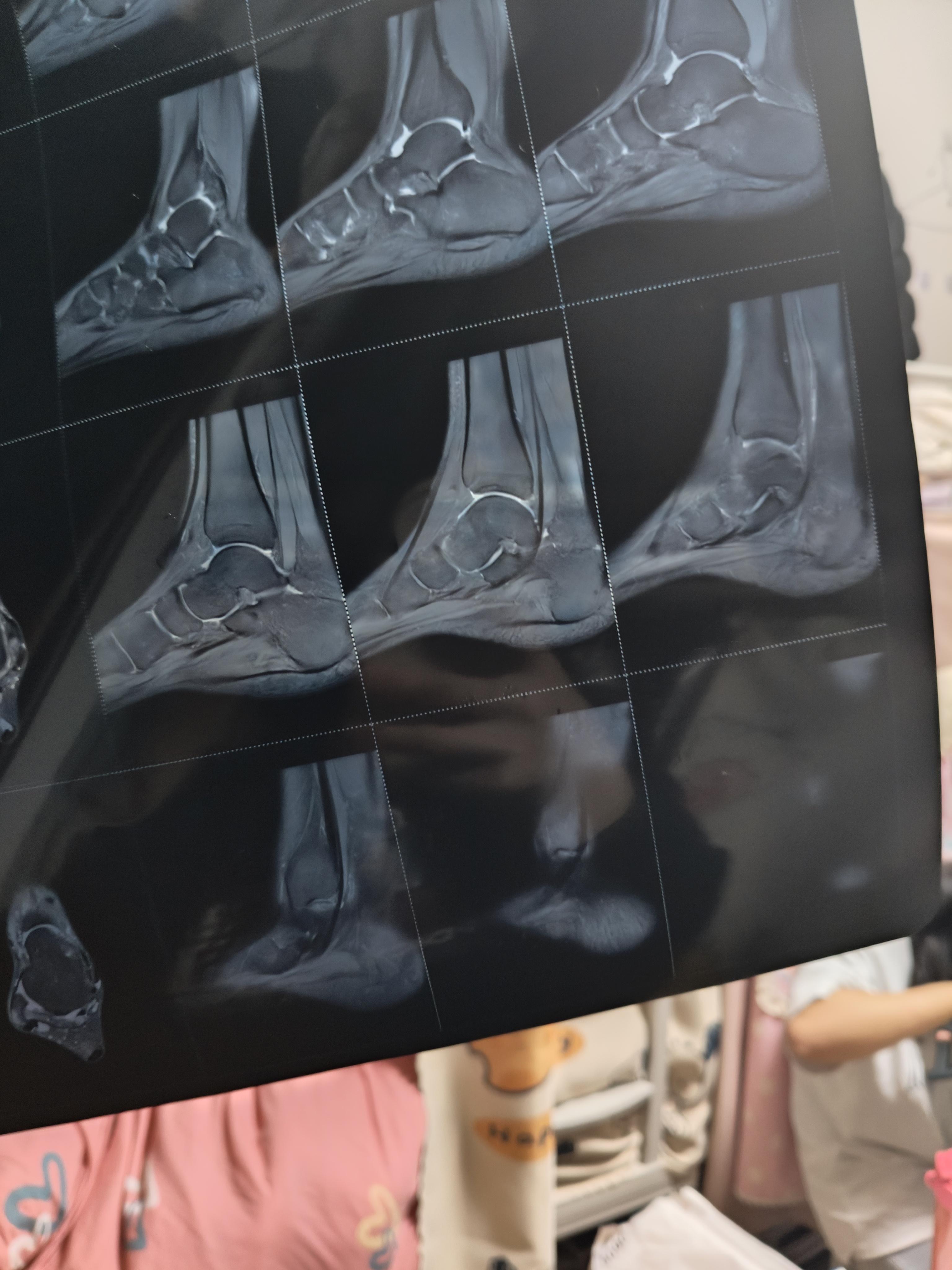 知乎用户imlerg 的想法: 求大神帮我看看我的磁共振片子😭😭