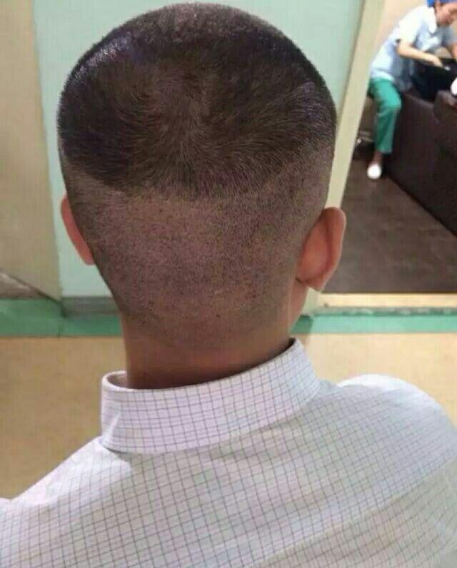 为什么秃顶的人这么多很少有做植发的?