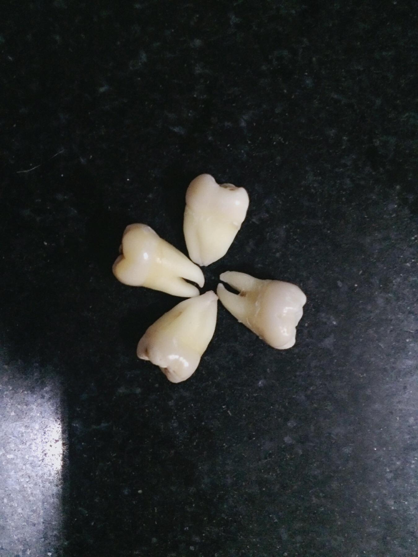 拔智齿有多痛? - 韩豆子的回答 - 知乎