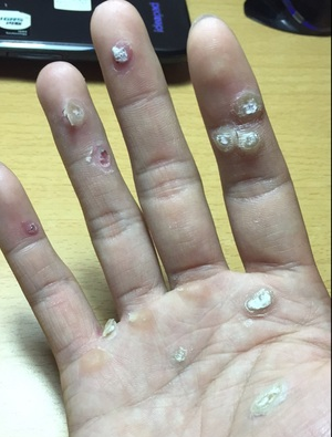 手上的瘊子(疣)越来越多有什么比较好的方法?