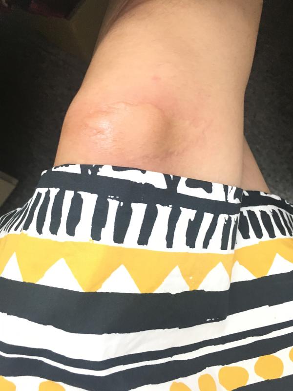 为什么有的人被蚊子咬后是起一个大包,有的人则是出现一个红点?