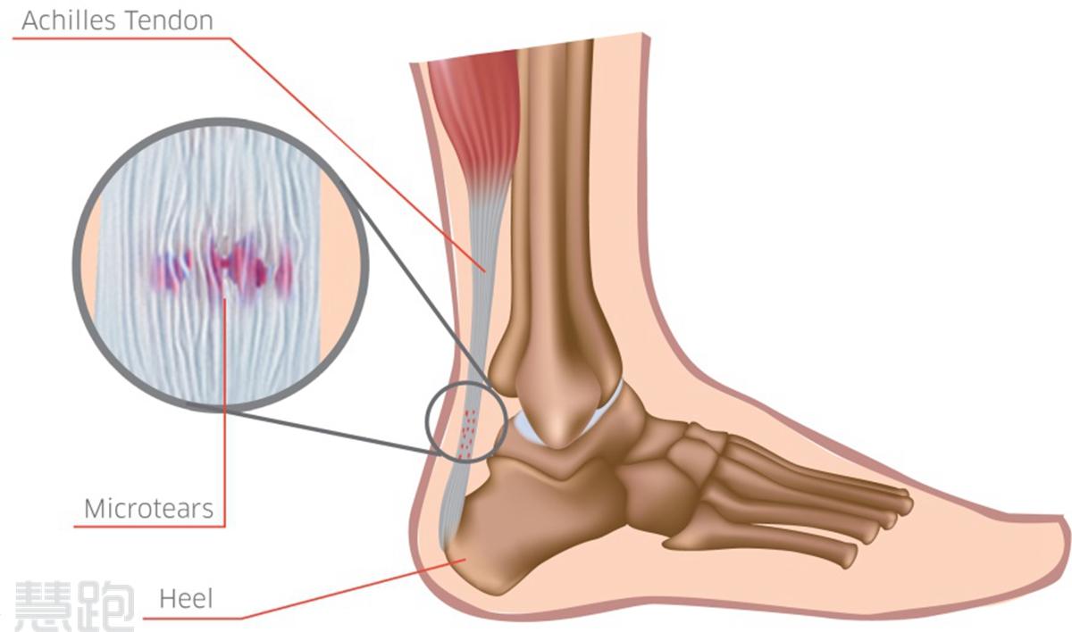 困扰我多年的跟腱病是如何康复的2