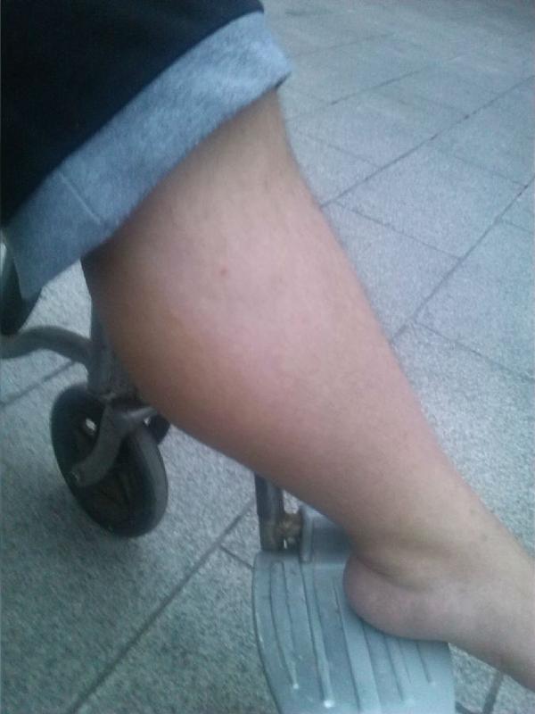 家里孩子出现了肌营养不良求好心人添加3393607305