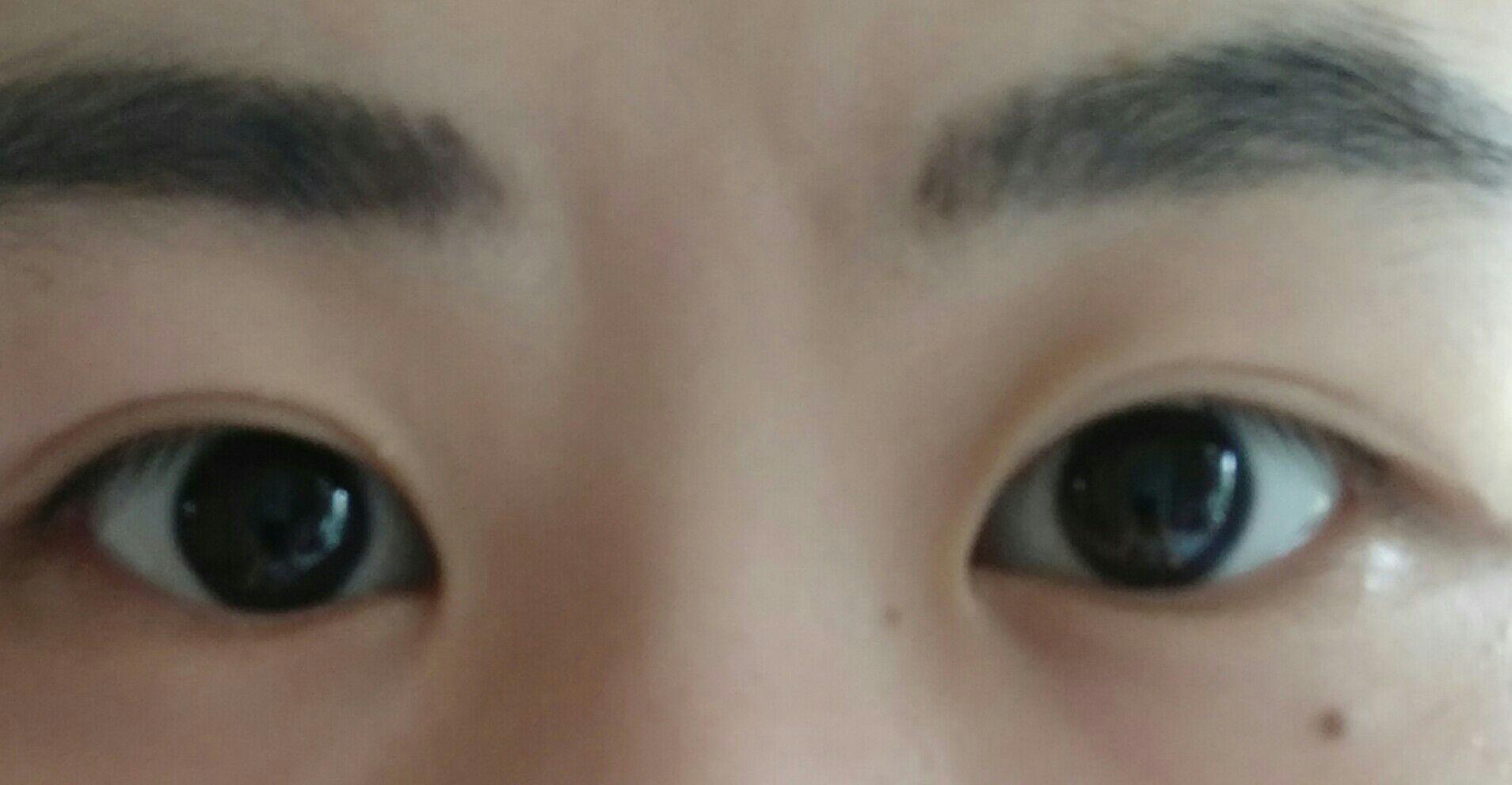 烦请专业人士帮我看看眼睛适不适合开眼角,想