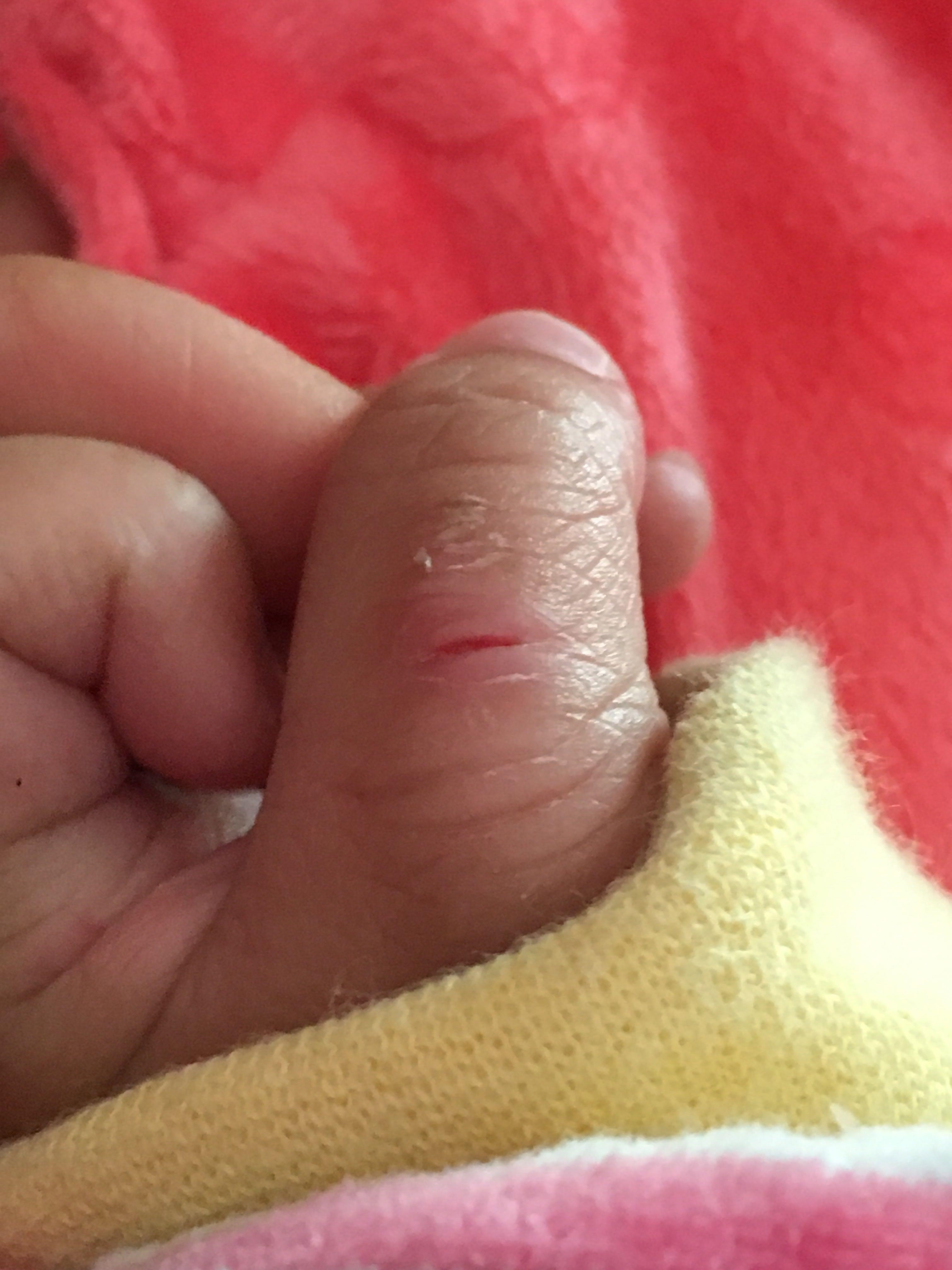 宝宝已经一岁了,很小就有吮手指头的习惯,入睡前要,睡熟了手指就会