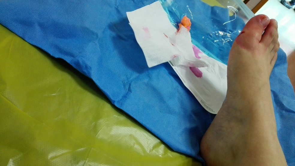 甲沟炎拔甲是怎样的体验?