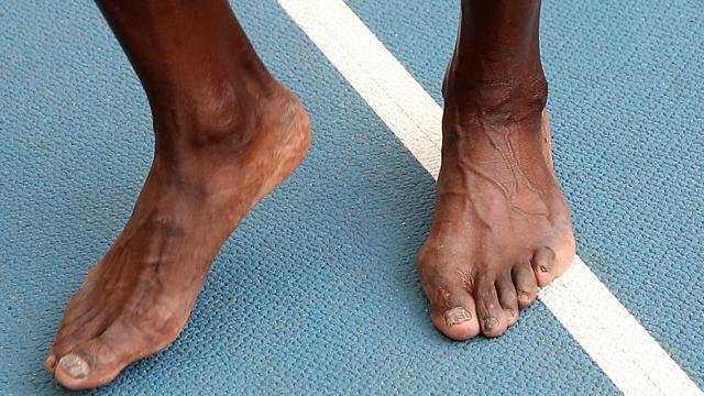 詹姆斯的脚真的是变形的吗?什么原因造成的?