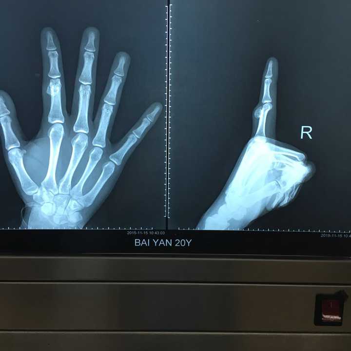 可能是个骨瘤之前我们医院有个病人,似乎手指跟你差不多