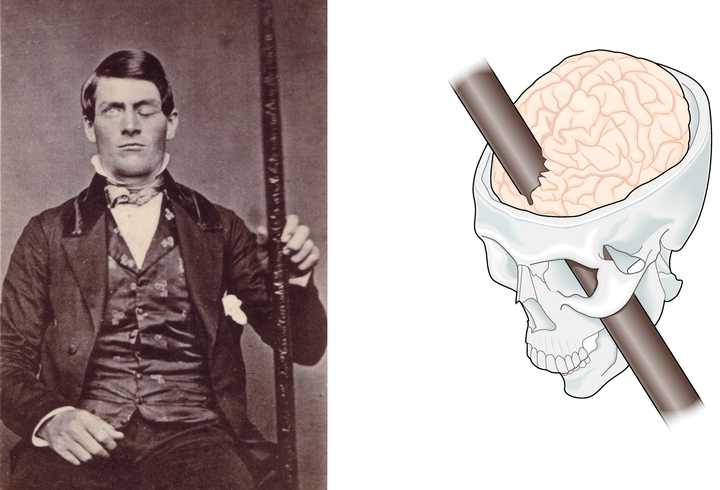 19世纪一个被钢管穿过额叶的铁道工phineas gage (图片来自神经