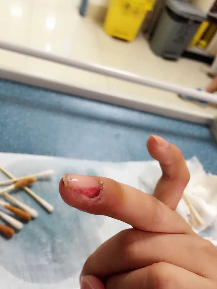 拔指甲是什么样的体验?很疼么?