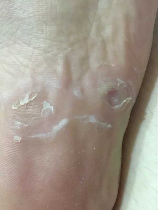 足底疣正确根治方法?