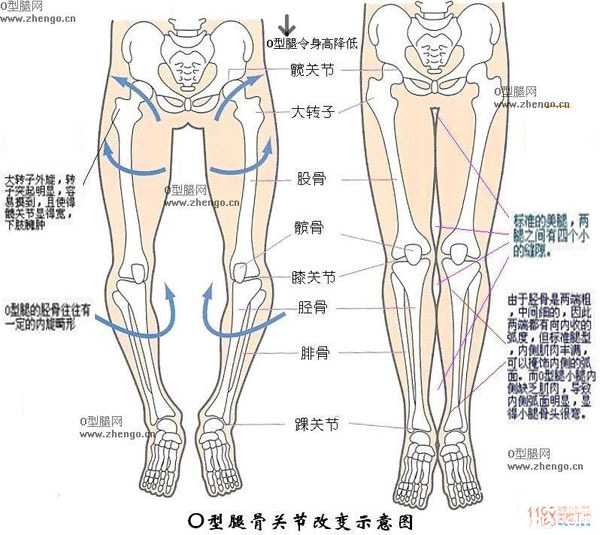 再来一个o型腿的解剖学图