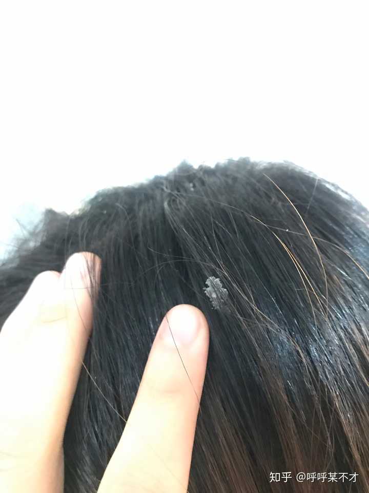 最大的头皮屑有多大,最大的头皮屑大块,头皮屑有_大山谷图库