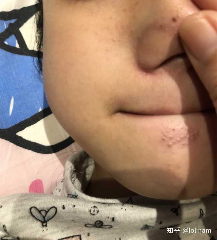 下巴反复长闭口 一大排密密麻麻还凸起怎么办 知乎