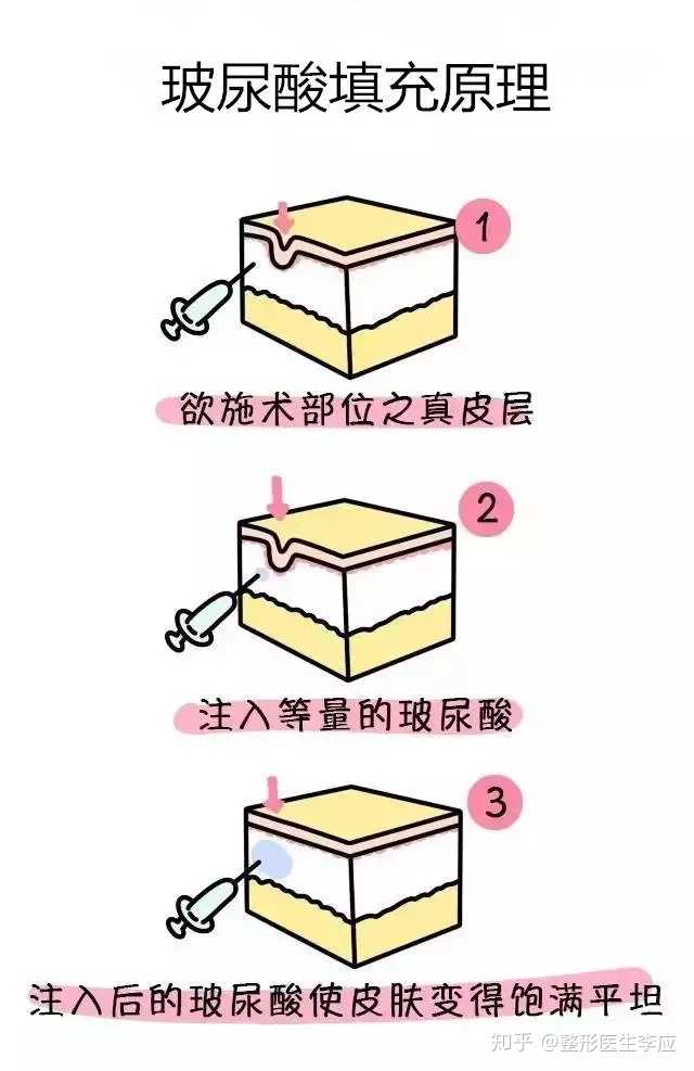 自体脂肪与玻尿酸对于填充来说那个材料更好?为什么?