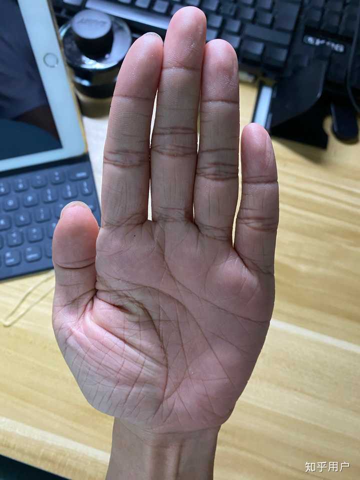 年纪轻轻23岁手上皮肤就很干有很多皱纹,像老年人干瘪的手,怎么办呀?