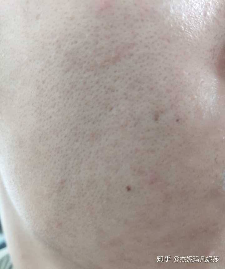 脸颊,虽然也是一个个黑点,只能说是"假黑头",其实根本不是黑头,就是