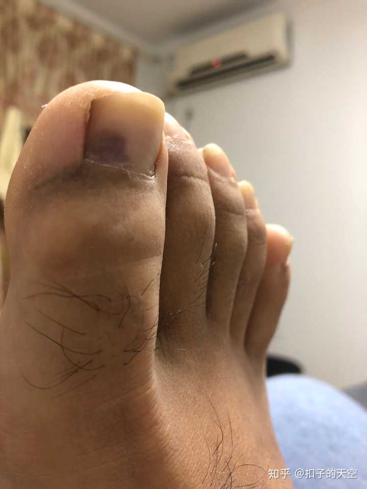 如何判断甲下黑色素瘤?