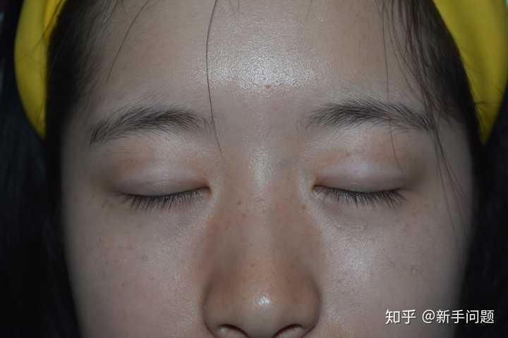 想知道有没有在福建省立医院丁力医生那里做过双眼皮的姐妹显示全部