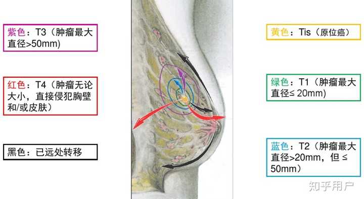 现在乳腺癌的治疗及存活率是怎样的 知乎