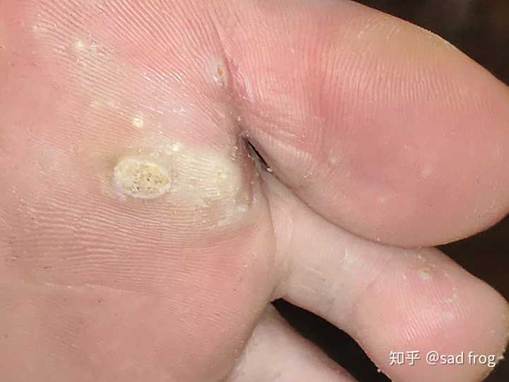 鸡眼怎么彻底挖出